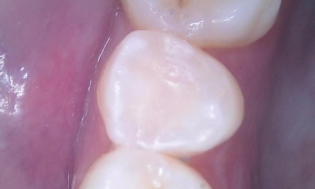 White Filling After