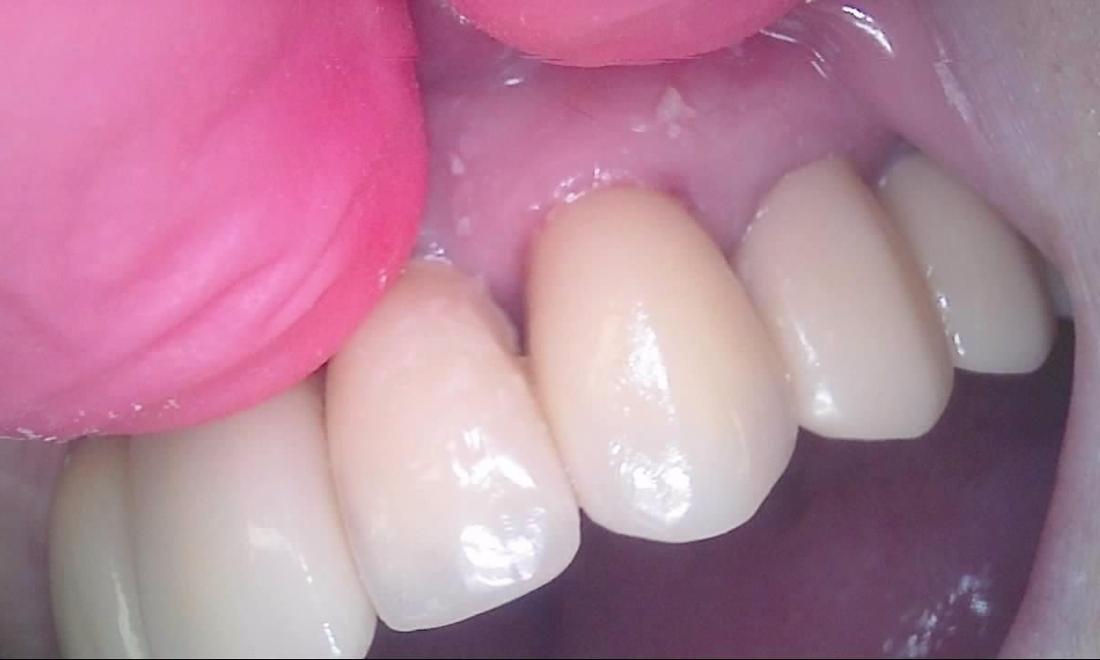 Broken Tooth | Palos Heights