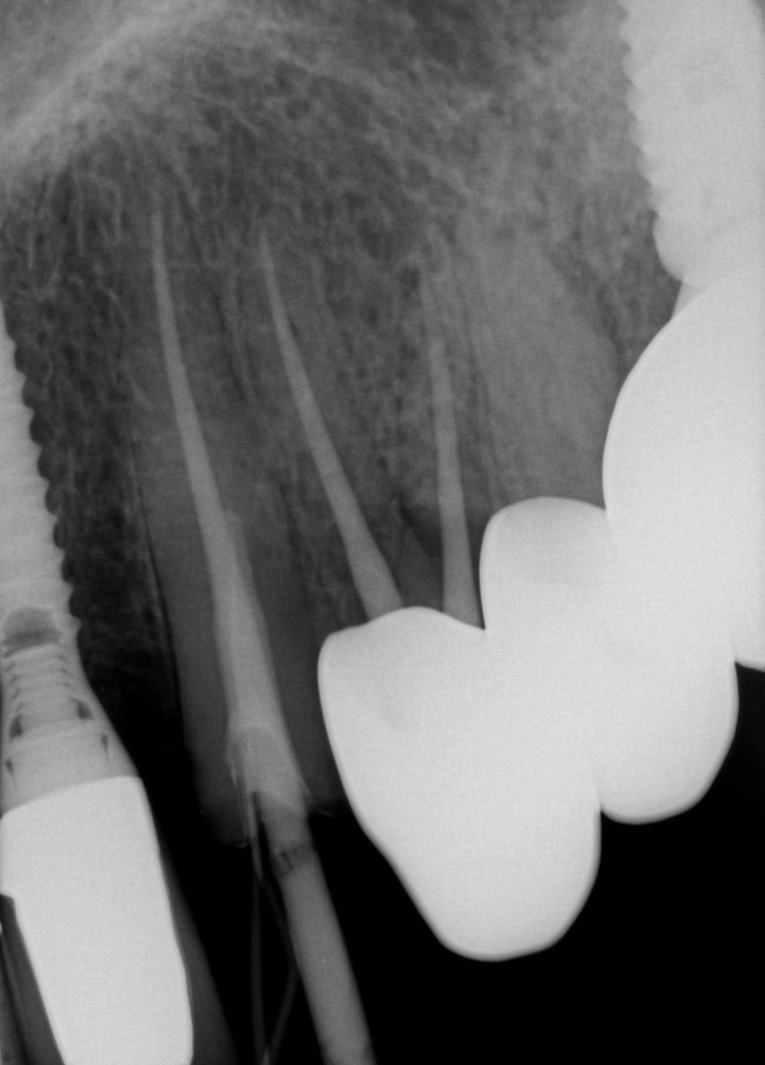 Broken Tooth | palos heights