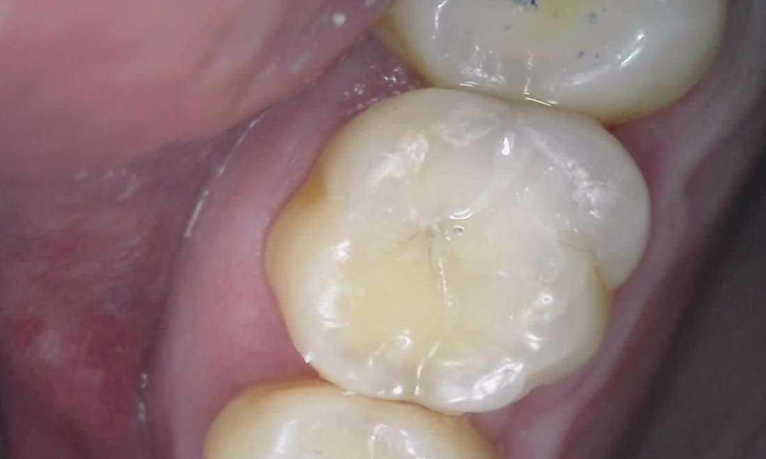 Deep Filling Final Fill
