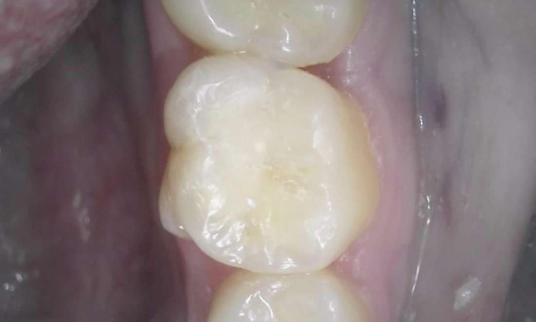 white filling in place