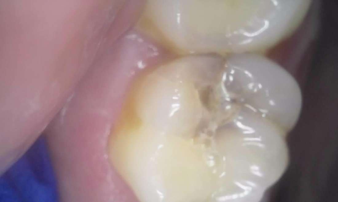 Deep Filling Pre Op
