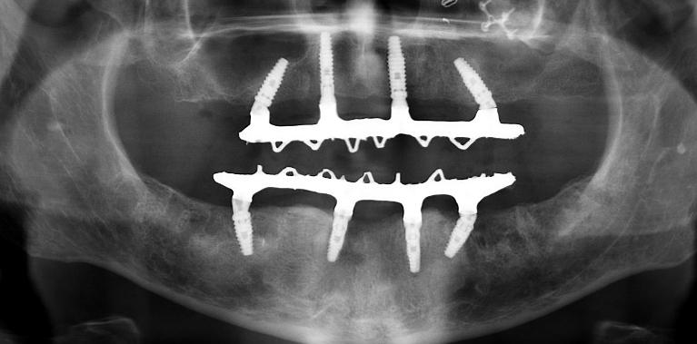 Implant-Retained-Dentures-After-Image