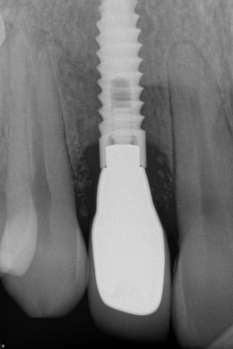 Implant-to-Replace-Single-Tooth-After-Image