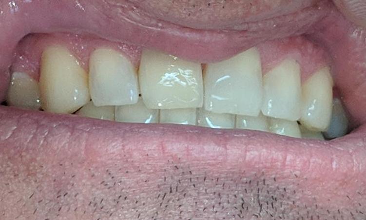 Invisalign-to-Close-Spaces-After-Image