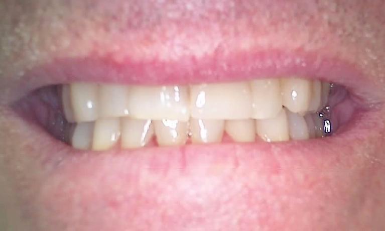 Screw-In-Implant-Crown-After-Image
