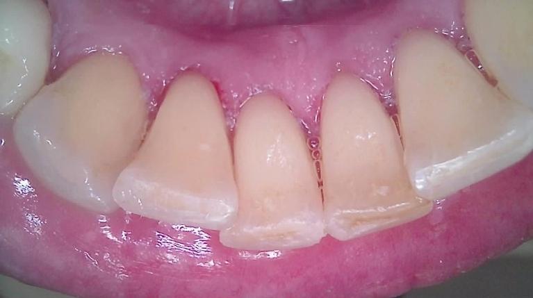 Teeth-Cleaning-After-Image