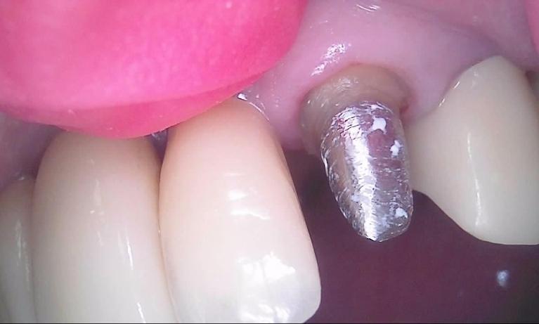 Post-and-core-and-crown-After-Image