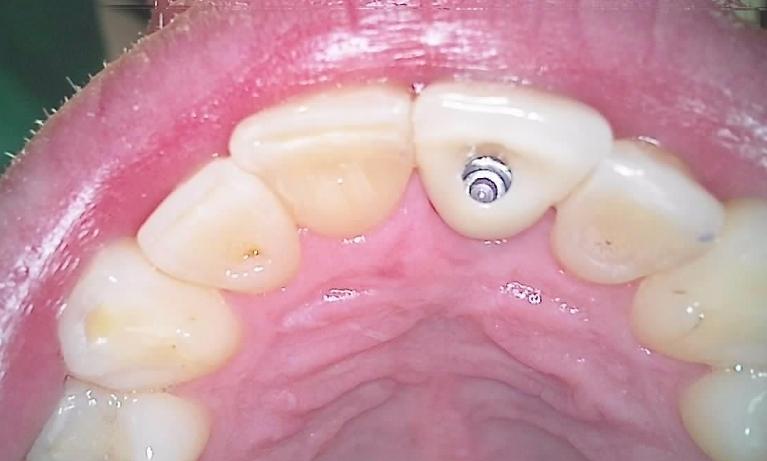 Screw down crow post op 2 | Palos Heights