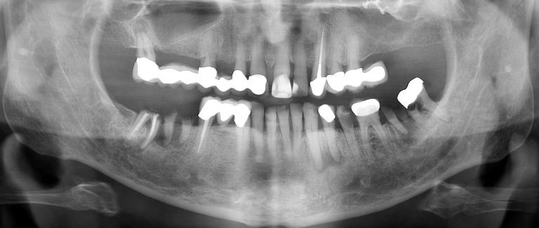 Implant-Retained-Dentures-Before-Image