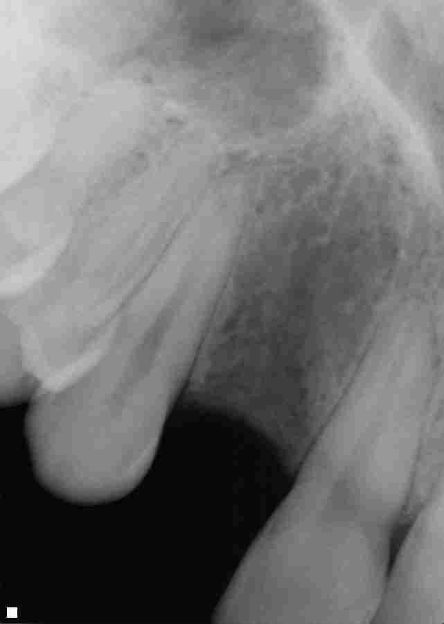 Implant-to-Replace-Single-Tooth-Before-Image