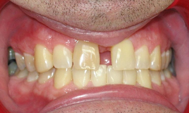 Invisalign-to-Close-Spaces-Before-Image