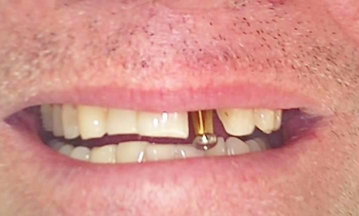 Screw-In-Implant-Crown-Before-Image