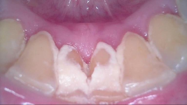 Teeth-Cleaning-Before-Image