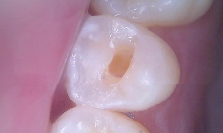 White Filling Before