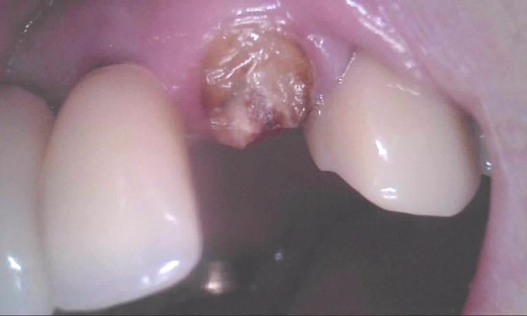 Broken Tooth | palos heights