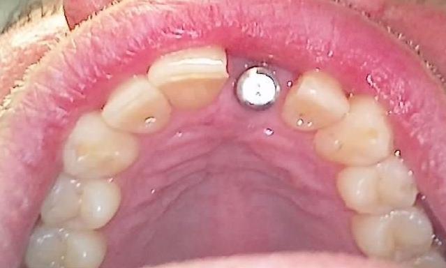 Screw down crown Preop2 | pPalos Heights