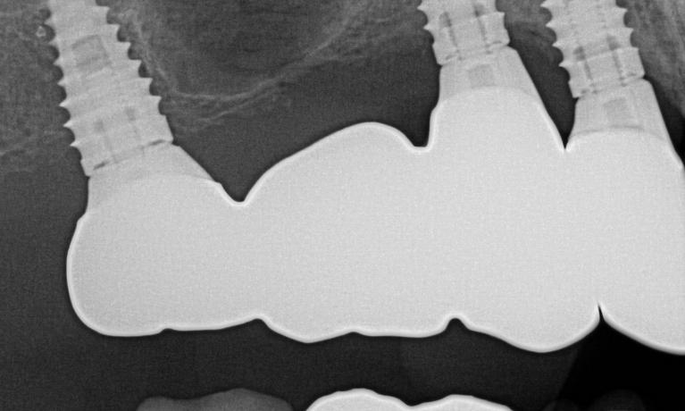 Xrays of crowns in place