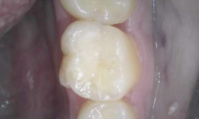 white filling in place