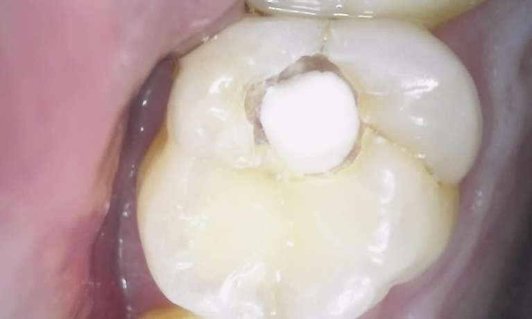 Deep Decay with Bioactive Protective Liner