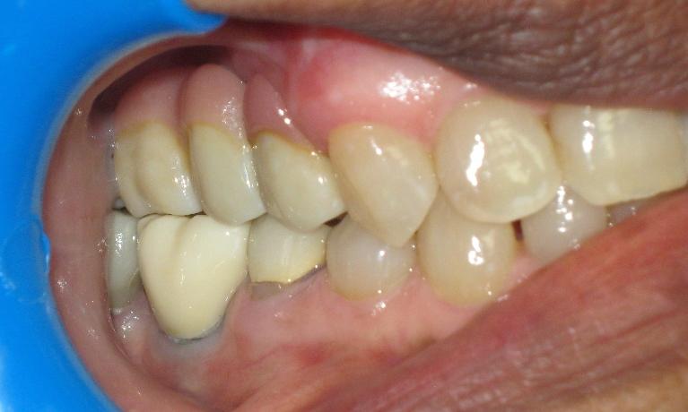 Crowns inserted in mouth