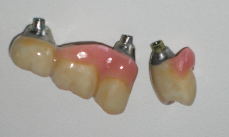 Crowns before insertion