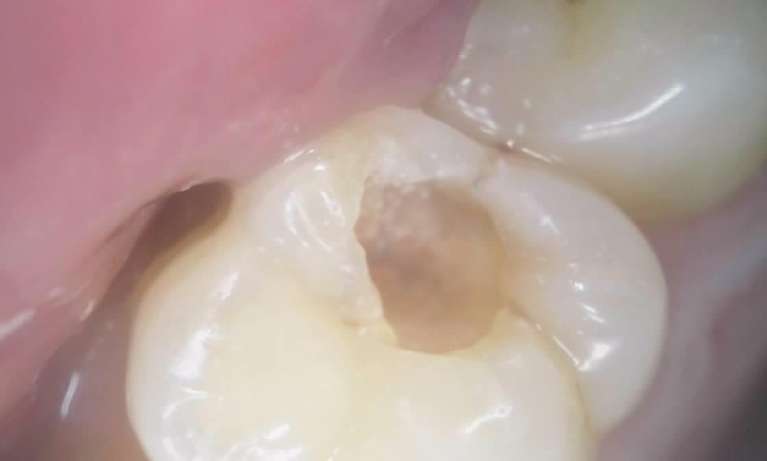 Deep Decay Cleaned Out