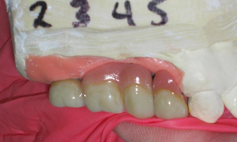 Crowns on plaster model